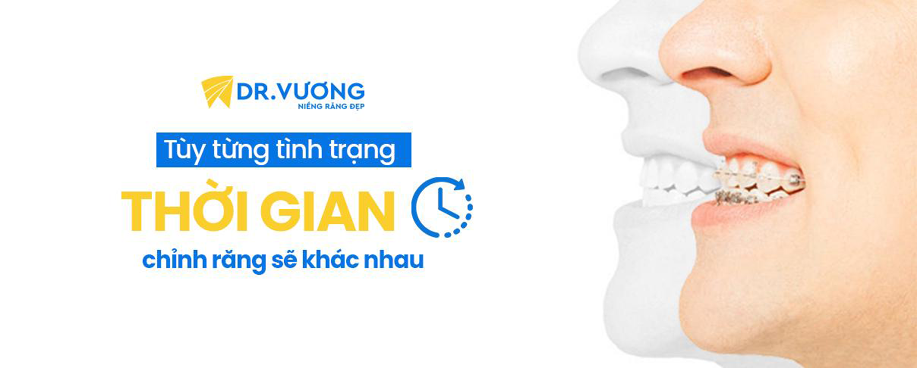 BẬT MÍ 4 PHƯƠNG PHÁP NIỀNG RĂNG TỐT NHẤT HIỆN NAY 7 3